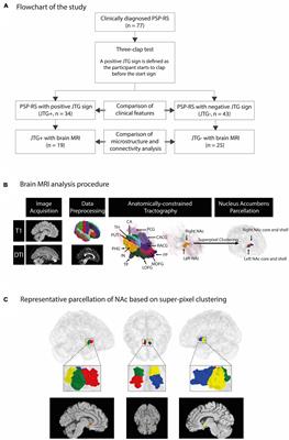 Waiting impulsivity in progressive supranuclear palsy-Richardson’s syndrome